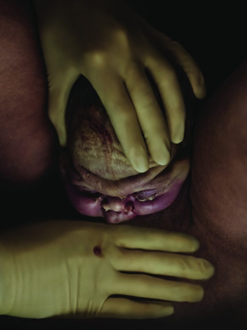 Close-up photo of gloved hands assisting in the birth of a baby