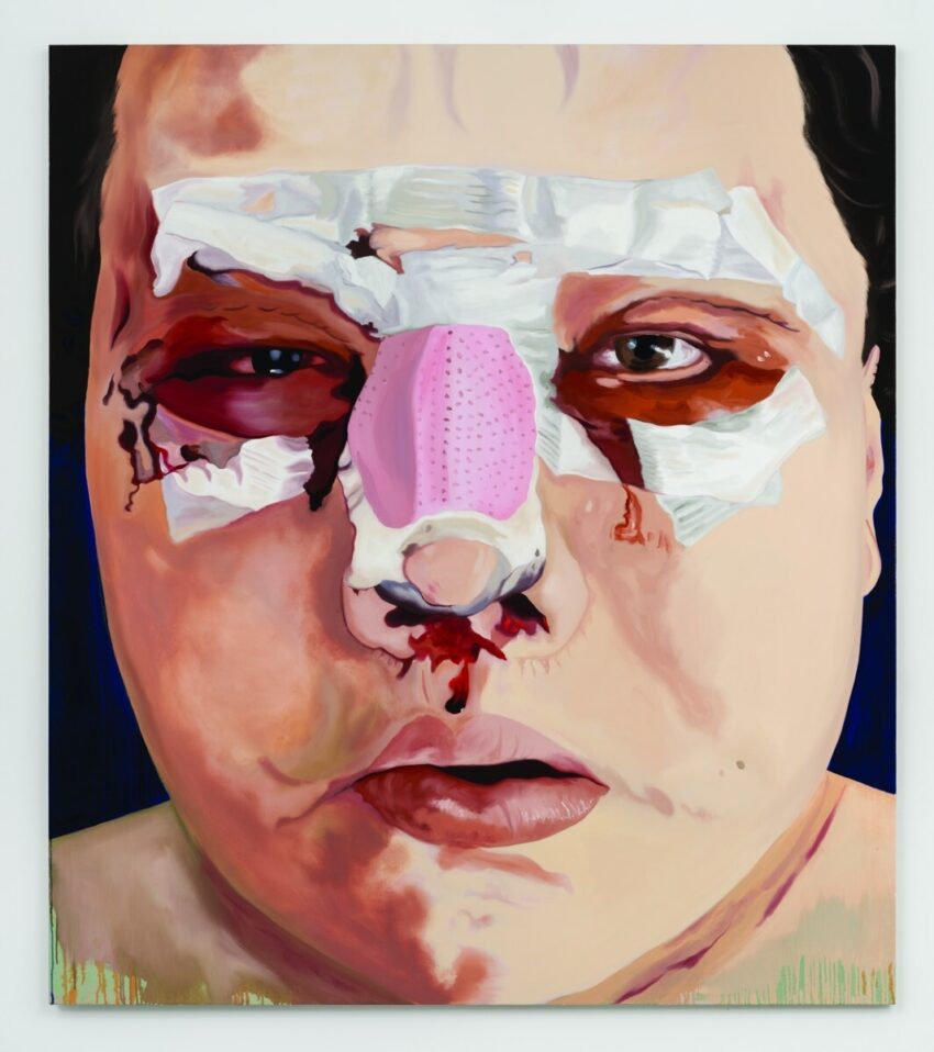 Victoria Cantons’s painting of a trans woman’s bandaged face after feminization surgery